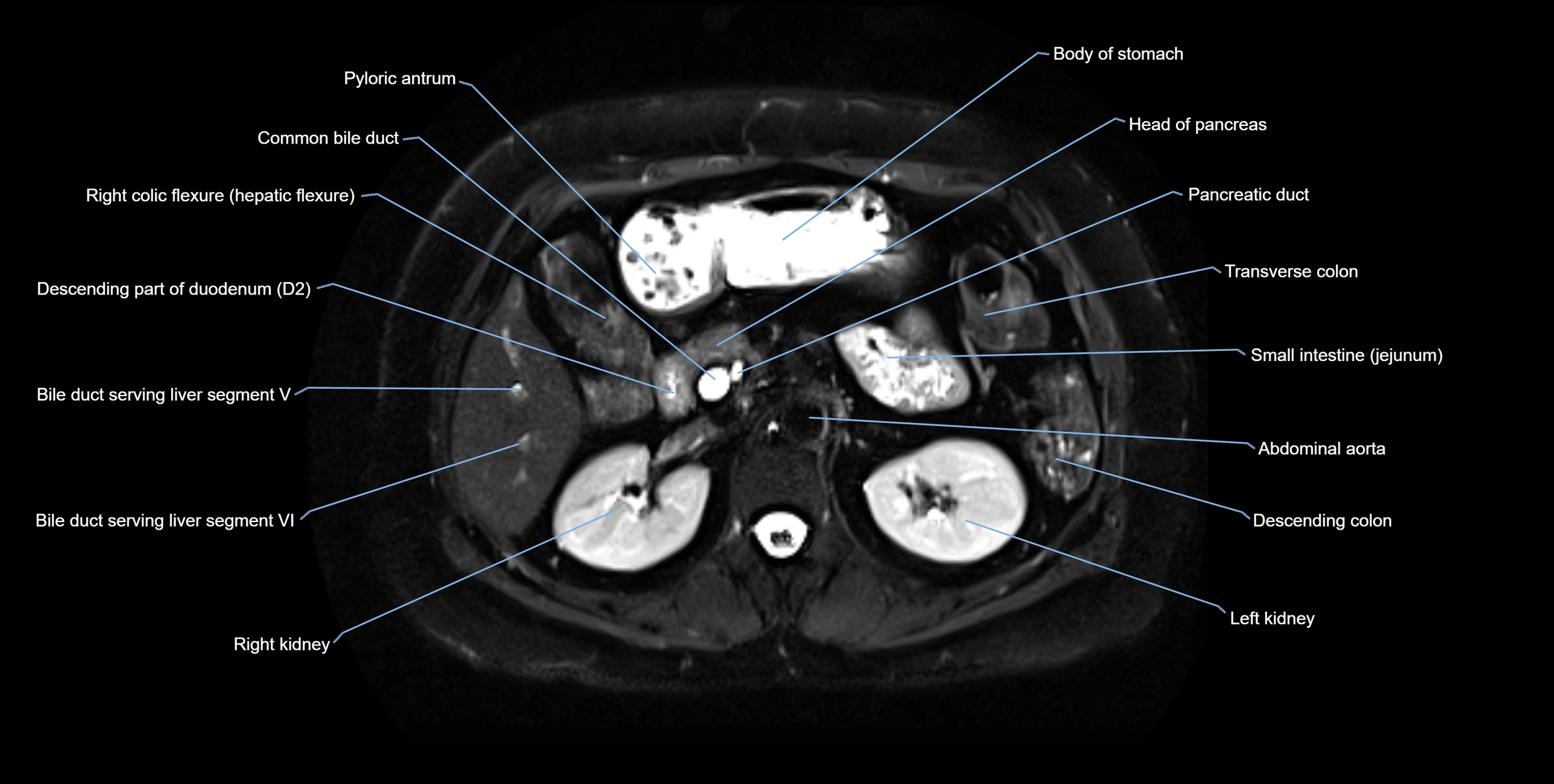 MRI MRCP axial cross sectional anatomy 3T radiology  image-img-10001-00024.webp